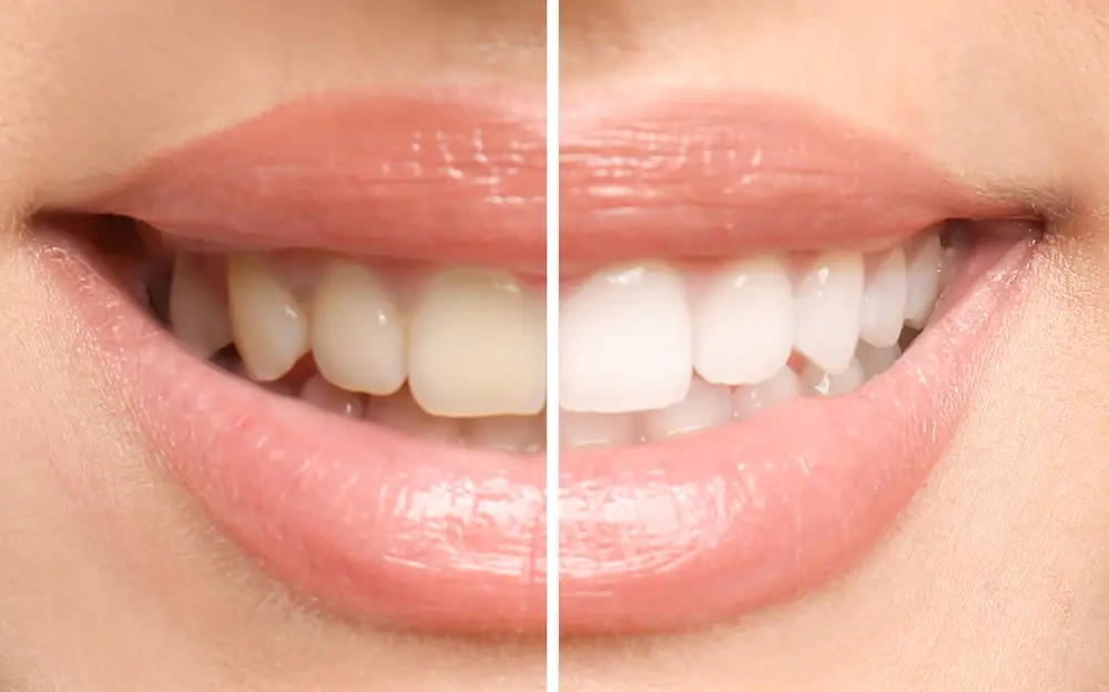Teeth whitening before and after